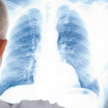 Fundação Portuguesa do Pulmão promove campanha de rastreios à Doença Pulmonar Obstrutiva Crónica